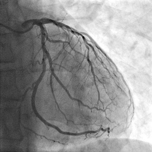 angiogram san angelo tx