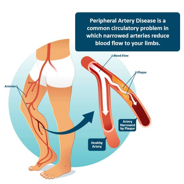 Peripheral Artery Disease Diagnosing PAD Causes Of P A D 