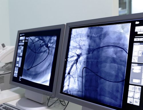 coronary angioplasty and stent treatments in San Angelo TX