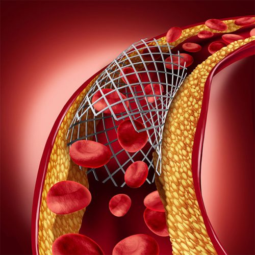 minimally invasive endovascular treatment for peripheral vascular disease - stent closeup