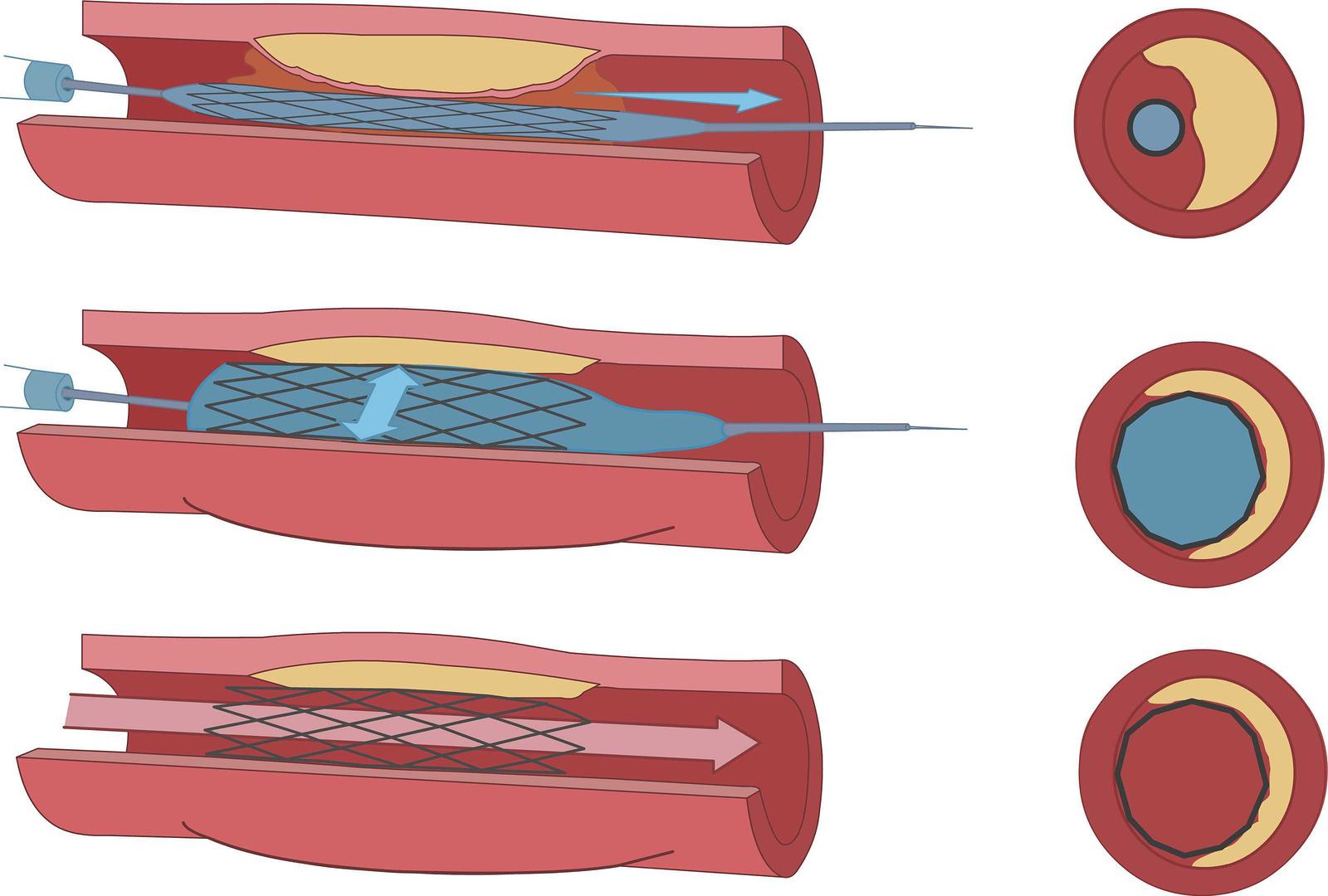 Endovascular Angioplasty and Stent Example Image - San Angelo Cardiovascular 